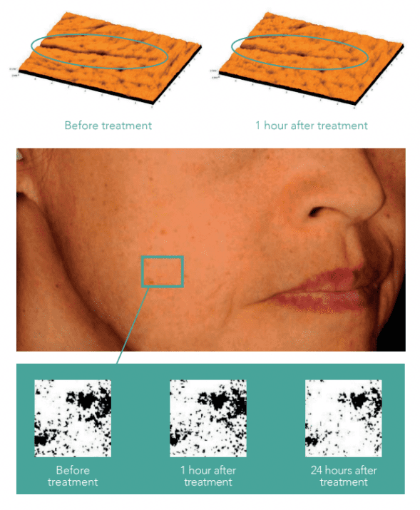 Lumination Peeling Facial Clinically Proven Results Lumination Peeling Facial Clinically Proven Results